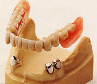 テレスコープ義歯